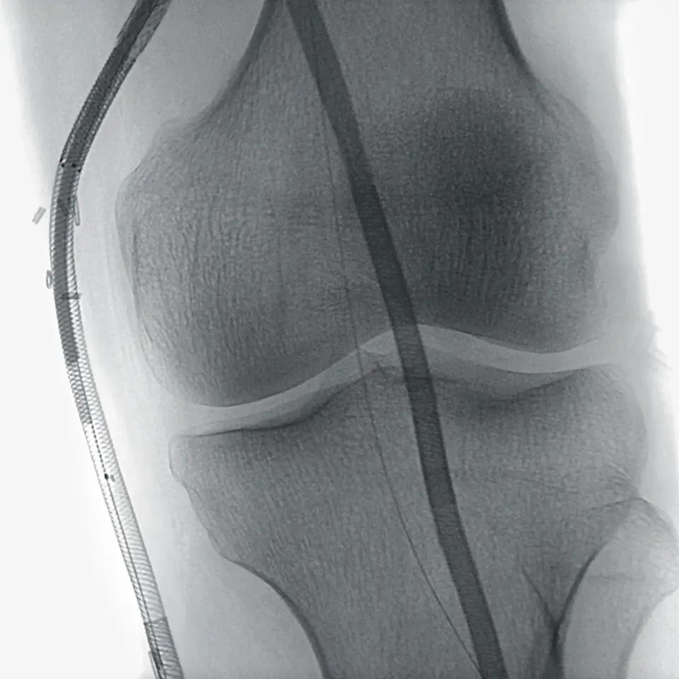 Stent Implantation