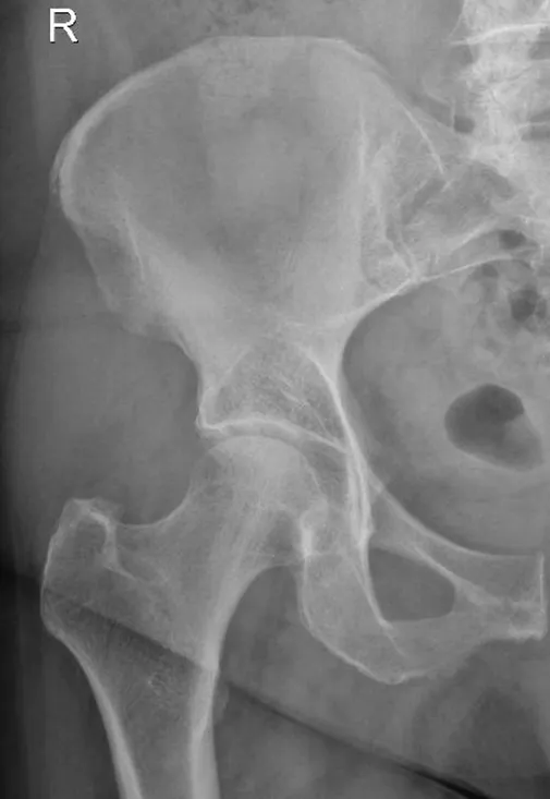 Normal Hip