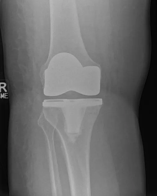 Total Knee Replacement Xray