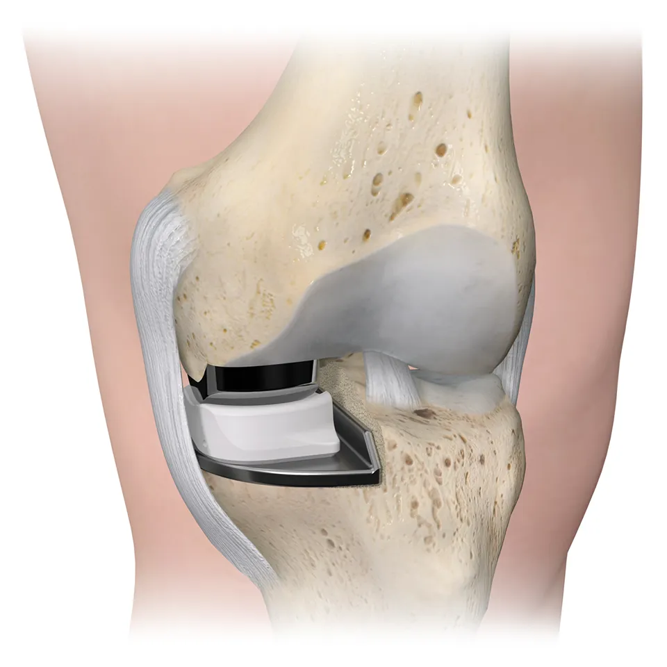 Oxford in bone with skin extension