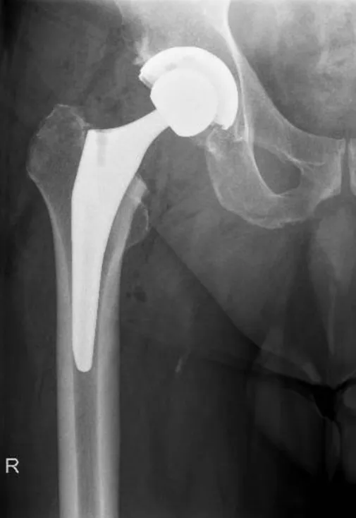 Uncemented Total Hip Replacement