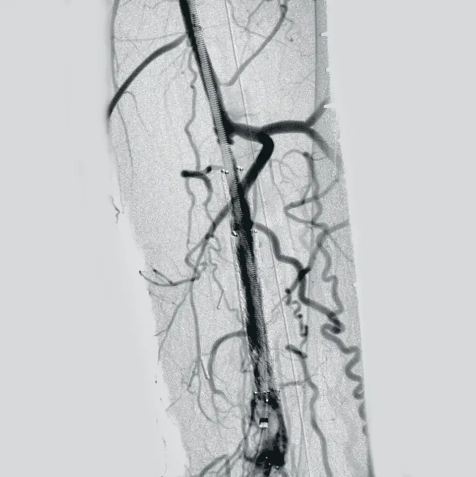 Angioplasty